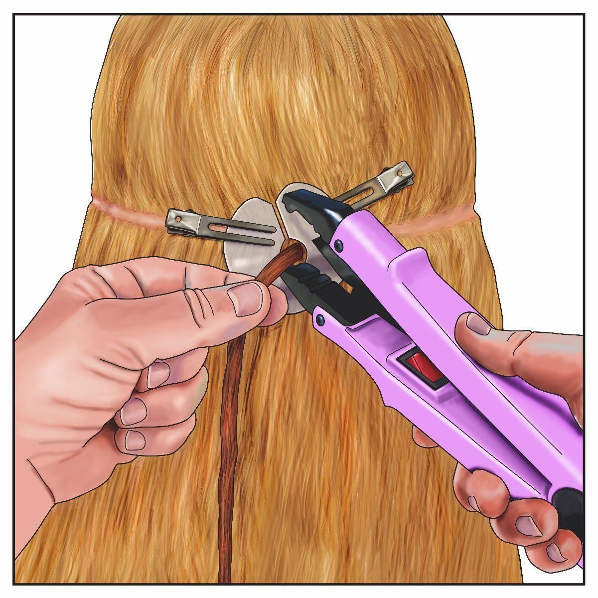 Attaching Bonding Extensions